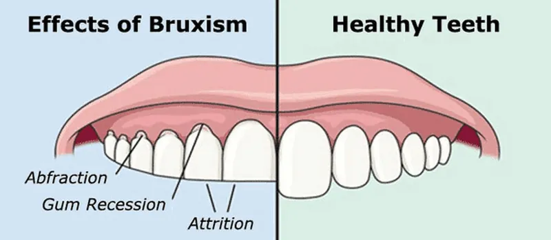 Effets du bruxisme comparés à des dents saines