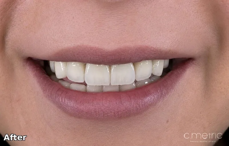 After: anterior crowns from canine to canine by Dr. Rita Kanbar