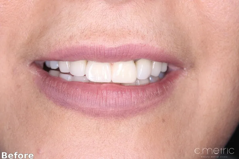 Before: worn, uneven front teeth. Anterior crowns case by Dr. Rita Kanbar