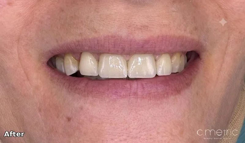 After: zirconia crowns closing the gap for a natural smile. Dr. Rita Kanbar