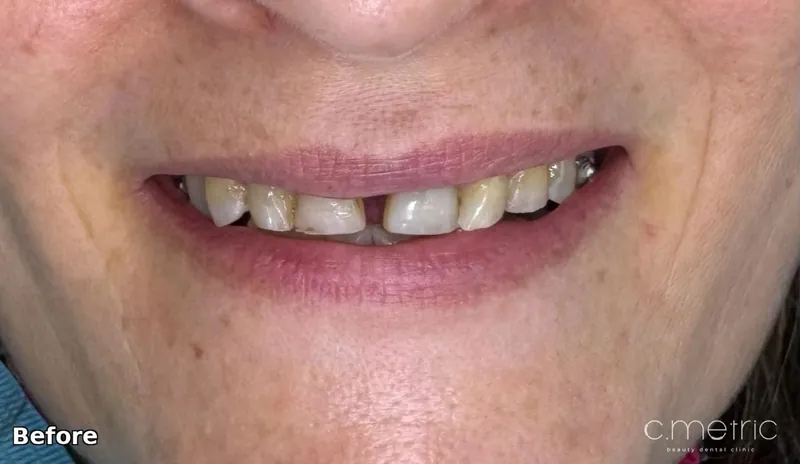 Before: midline gap and missing canine. Case by Dr. Rita Kanbar