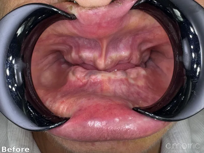 Before: missing teeth across both arches. Case by Dr. Rita Kanbar