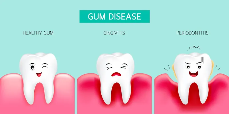 Illustration of healthy and inflamed gums