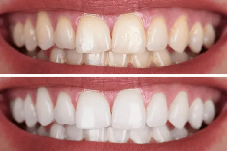 Teeth before and after whitening